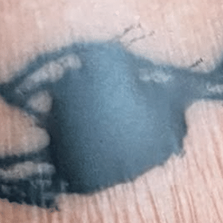 Voorbeeld van een normale inktblaas of plasmablaas onder second skin folie na een tattoo